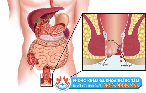 Những cách điều trị bệnh trĩ thông dụng