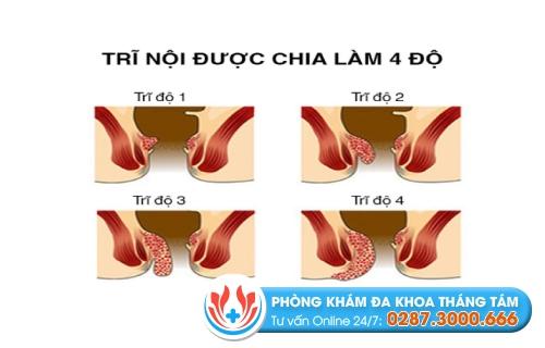 Những cấp độ của bệnh trĩ
